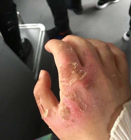 手被烫伤后起水泡怎么办？如何正确处理和护理？