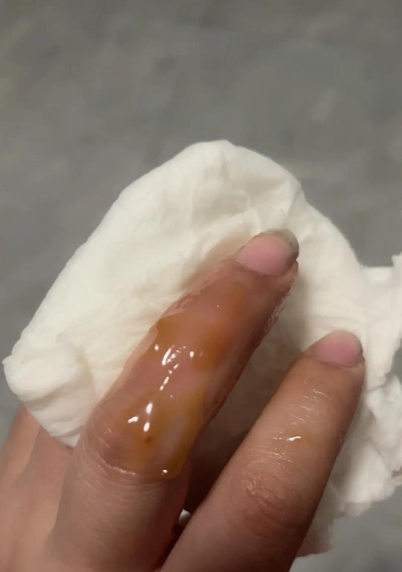 手被烫伤后起水泡怎么办？如何正确处理和护理？
